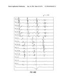 ATRIAL FIBRILLATION TREATMENT SYSTEMS AND METHODS diagram and image