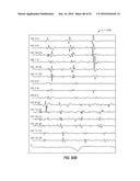 ATRIAL FIBRILLATION TREATMENT SYSTEMS AND METHODS diagram and image