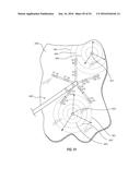 ATRIAL FIBRILLATION TREATMENT SYSTEMS AND METHODS diagram and image