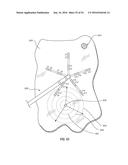 ATRIAL FIBRILLATION TREATMENT SYSTEMS AND METHODS diagram and image