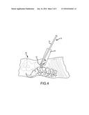 Devices and Methods for Preparing an Intervertebral Workspace diagram and image