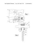 UNIPLANAR BONE ANCHOR SYSTEM diagram and image