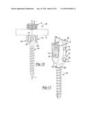 UNIPLANAR BONE ANCHOR SYSTEM diagram and image