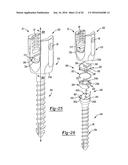 UNIPLANAR BONE ANCHOR SYSTEM diagram and image