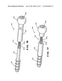 Bioactive Fusion Device diagram and image