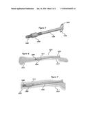 INTRAMEDULLARY ANCHOR-SCREW FRACTURE FIXATION diagram and image