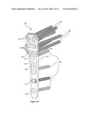 BONE PLATE WITH ELEVATED SUTURE HOLE STRUCTURES diagram and image