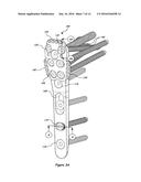 BONE PLATE WITH ELEVATED SUTURE HOLE STRUCTURES diagram and image