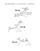 SCLERAL PROSTHESIS FOR TREATING PRESBYOPIA AND OTHER EYE DISORDERS AND     RELATED DEVICES AND METHODS diagram and image