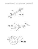 SCLERAL PROSTHESIS FOR TREATING PRESBYOPIA AND OTHER EYE DISORDERS AND     RELATED DEVICES AND METHODS diagram and image