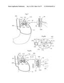 DEVICE FOR TREATING OBESITY diagram and image