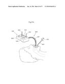 DEVICE FOR TREATING OBESITY diagram and image