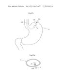 DEVICE FOR TREATING OBESITY diagram and image