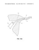 OCCLUSION DEVICE WITH OPENABLE CHANNEL diagram and image