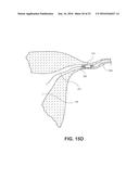 OCCLUSION DEVICE WITH OPENABLE CHANNEL diagram and image