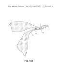 OCCLUSION DEVICE WITH OPENABLE CHANNEL diagram and image