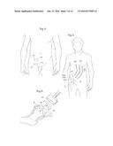 HIP JOINT DEVICE AND METHOD diagram and image