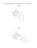 HIP JOINT DEVICE AND METHOD diagram and image