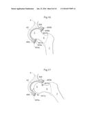 HIP JOINT DEVICE AND METHOD diagram and image