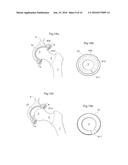 HIP JOINT DEVICE AND METHOD diagram and image