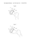 HIP JOINT DEVICE AND METHOD diagram and image