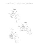 HIP JOINT DEVICE AND METHOD diagram and image