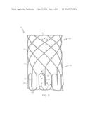 ENDOLUMINAL DEVICE diagram and image