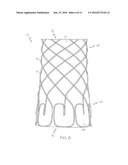 ENDOLUMINAL DEVICE diagram and image