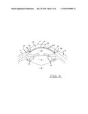 CORNEAL IMPLANT AND METHOD OF DELIVERING A CORNEAL IMPLANT diagram and image