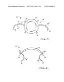 CORNEAL IMPLANT AND METHOD OF DELIVERING A CORNEAL IMPLANT diagram and image