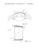 CORNEAL IMPLANT AND METHOD OF DELIVERING A CORNEAL IMPLANT diagram and image