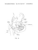 METHOD AND APPARATUS FOR TREATING A HIP JOINT, INCLUDING THE PROVISION AND     USE OF A NOVEL SUTURE PASSER diagram and image