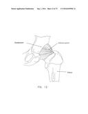 METHOD AND APPARATUS FOR TREATING A HIP JOINT, INCLUDING THE PROVISION AND     USE OF A NOVEL SUTURE PASSER diagram and image