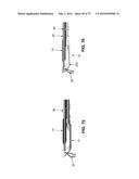 METHOD AND APPARATUS FOR TREATING A HIP JOINT, INCLUDING THE PROVISION AND     USE OF A NOVEL SUTURE PASSER diagram and image