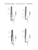 METHOD AND APPARATUS FOR TREATING A HIP JOINT, INCLUDING THE PROVISION AND     USE OF A NOVEL SUTURE PASSER diagram and image