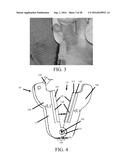 Devices and Methods for Removing Unwanted Tissue diagram and image