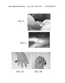 Devices and Methods for Removing Unwanted Tissue diagram and image