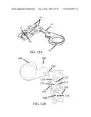 Devices and Methods for Removing Unwanted Tissue diagram and image