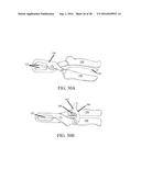 Devices and Methods for Removing Unwanted Tissue diagram and image