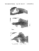 SYSTEM AND METHOD FOR ALIGNING VERTEBRAE IN THE AMELIORATION OF ABERRANT     SPINAL COLUMN DEVIATION CONDITIONS diagram and image