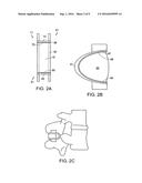 Dynamized Interspinal Implant diagram and image