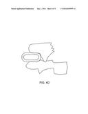 Dynamized Interspinal Implant diagram and image