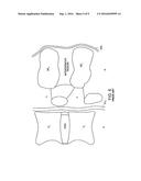 Dynamized Interspinal Implant diagram and image