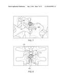 EXPANDABLE INTERSPINOUS DEVICE diagram and image