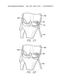 METHOD FOR AMELIORATING JOINT CONDITIONS AND DISEASES AND PREVENTING BONE     HYPERTROPHY diagram and image