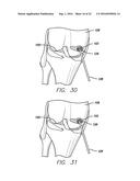 METHOD FOR AMELIORATING JOINT CONDITIONS AND DISEASES AND PREVENTING BONE     HYPERTROPHY diagram and image