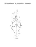 Gender Specific Implant and Packaging diagram and image