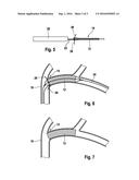 STENT COMPRISING A RETAINING ELEMENT diagram and image
