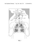 BI-LATERAL ENDOBRONCHIAL SUCTIONING DEVICE AND MEDICAL SUCTIONING SYSTEM     FOR INTUBATED PATIENTS diagram and image
