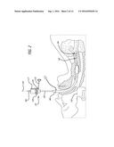 BI-LATERAL ENDOBRONCHIAL SUCTIONING DEVICE AND MEDICAL SUCTIONING SYSTEM     FOR INTUBATED PATIENTS diagram and image